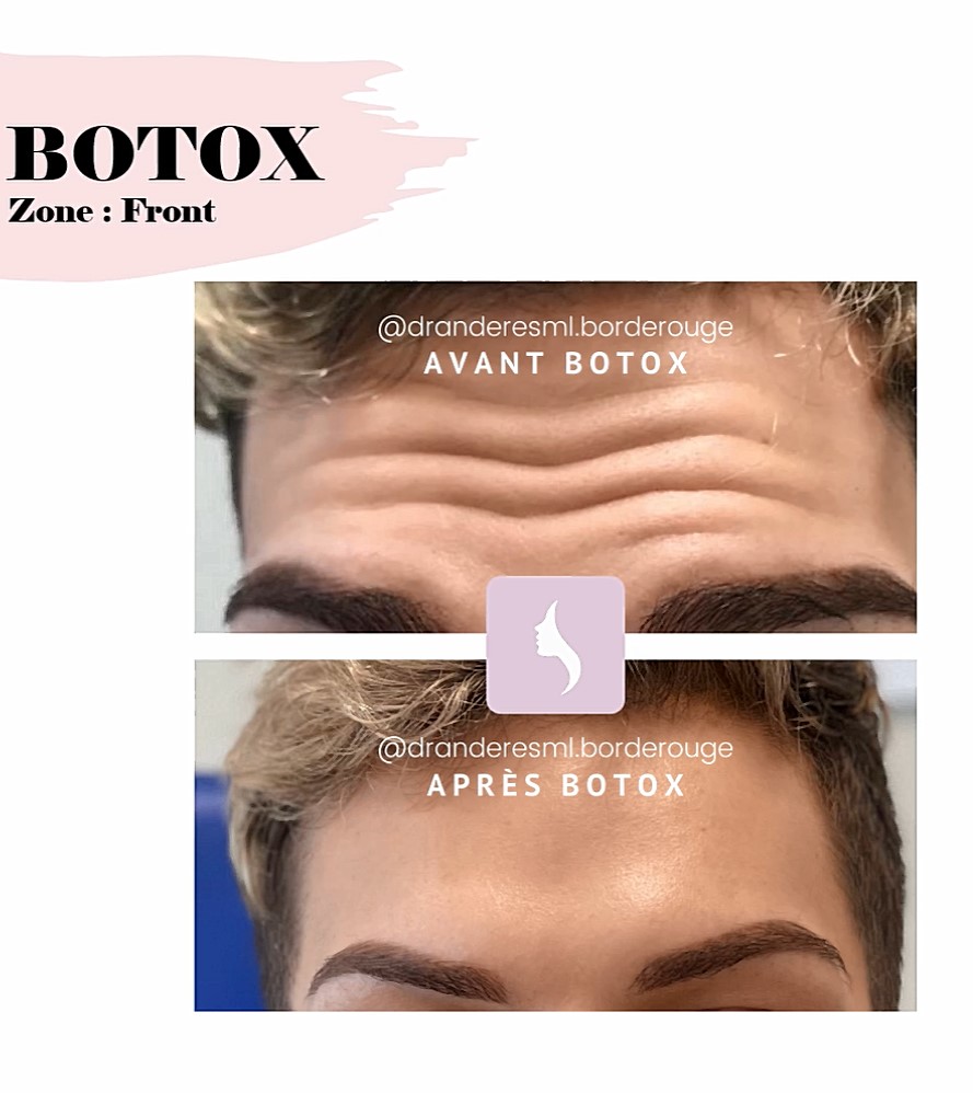 Résultat avant / après Botox sur les rides du front, cabinet du Dr Anderes à Toulouse