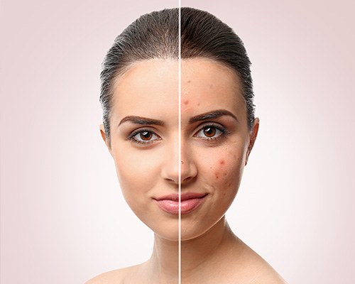 Traitement de l’acné : peau du visage avec et sans imperfections