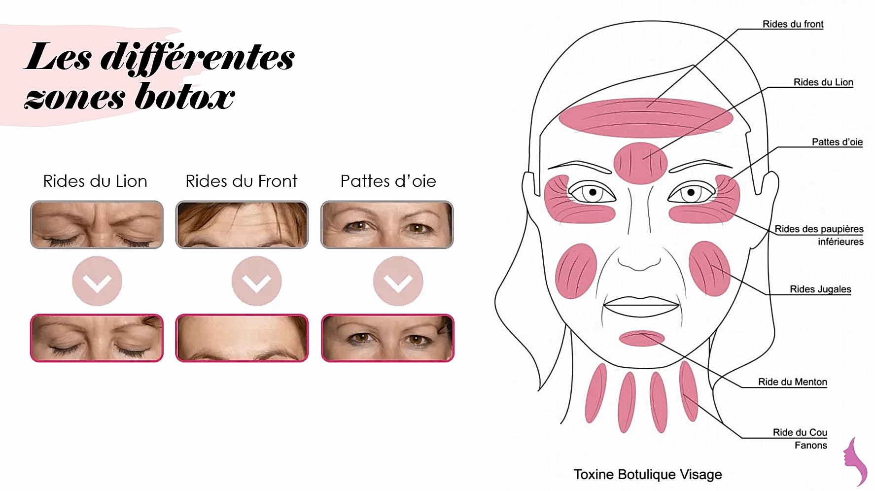 Schéma des zones traitées au Botox : rides du front, du lion, pattes d’oie, menton et cou